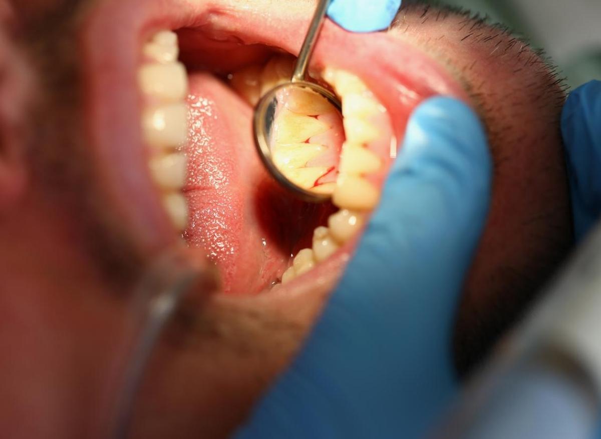 Parodontite : les statines réduiraient l’inflammation des gencives