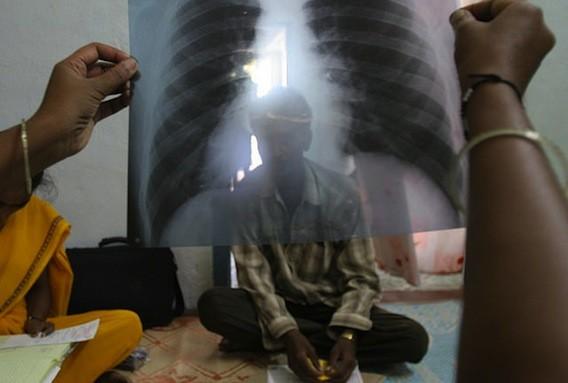 Tuberculoses multirésistantes : accès limité aux dernières thérapies