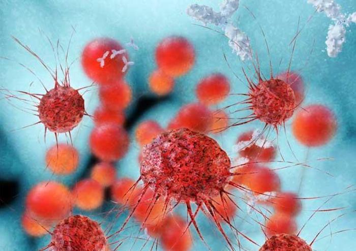 Cancer du poumon : l’immunothérapie néoadjuvante réduit le risque de rechute 