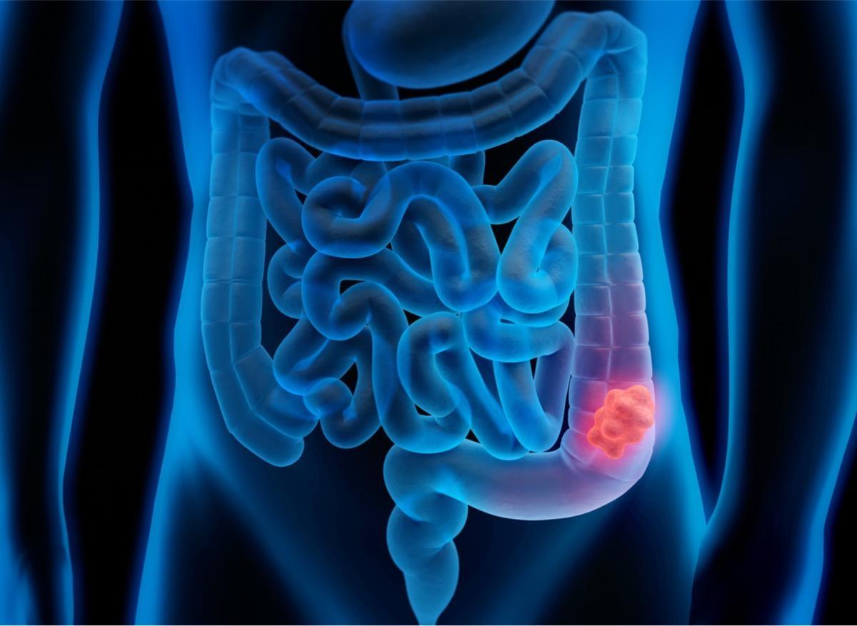 Cancer du colon : le risque ne concerne pas que les proches au 1er degré  