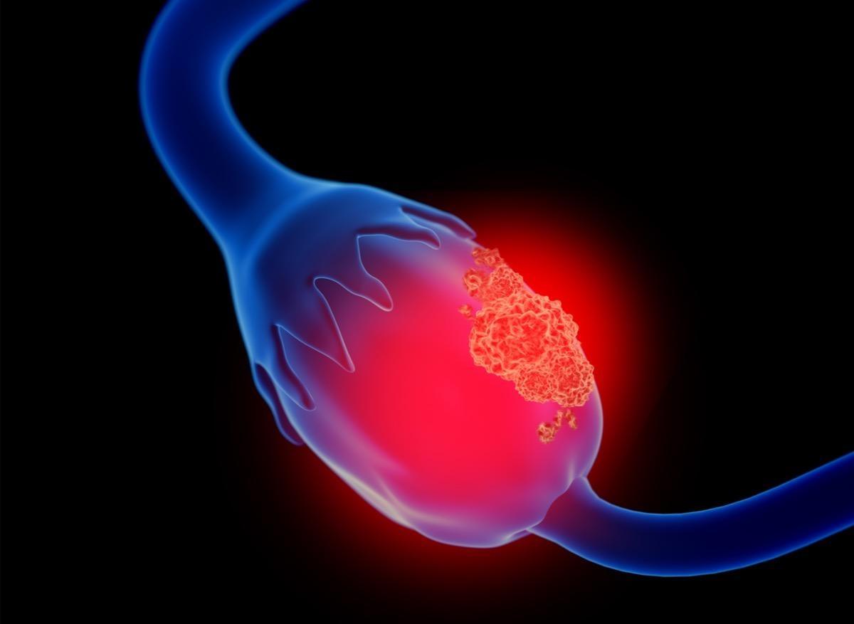 Cancer des ovaires : la chirurgie peut préserver la fertilité en cas de bordeline