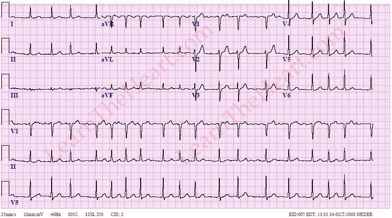 Fibrillation atriale : l’obésité est bien une cause directe 