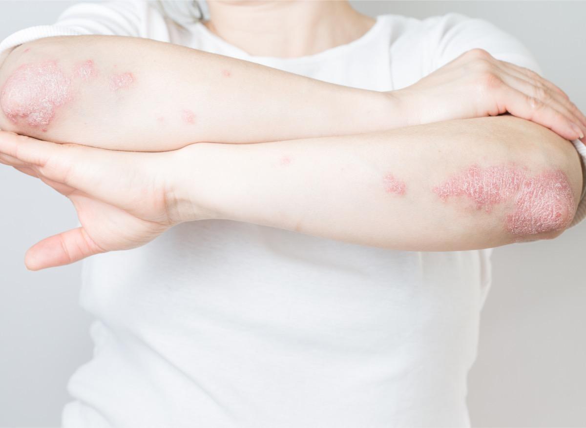 Psoriasis : la gravité de la maladie serait liée à l'IFN Kappa 