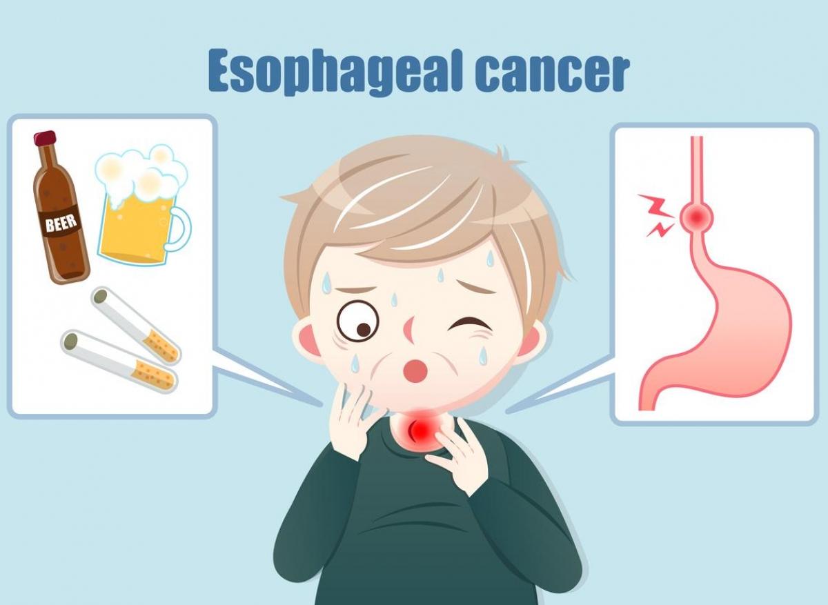 Cancer de l'oesophage : triplement des cas chez les moins de 50 ans