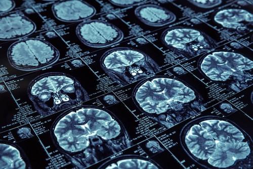 Alzheimer : la barrière hémato-encéphalique serait poreuse très tôt