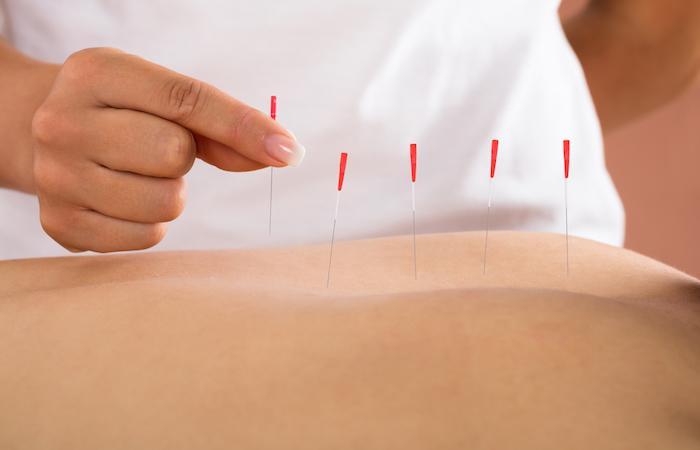 Cancer du sein : l'acupuncture intéressante pour soulager les douleurs