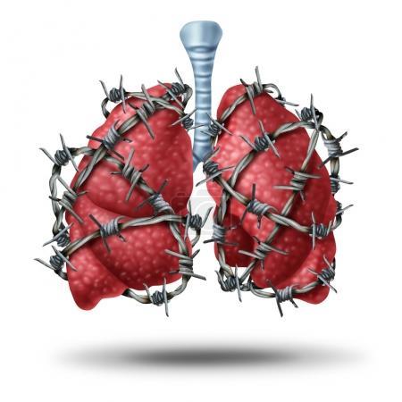 Critères diagnostiques de la fibrose pulmonaire idiopathique :  les recommandations de la Fleischner Society