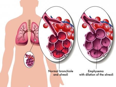 Emphysème : les résultats à 2 ans des coïls endobronchiques sont encourageants