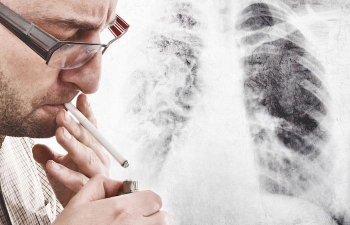 Cancer du poumon localement étendu : les vrais espoirs de l’immunothérapie