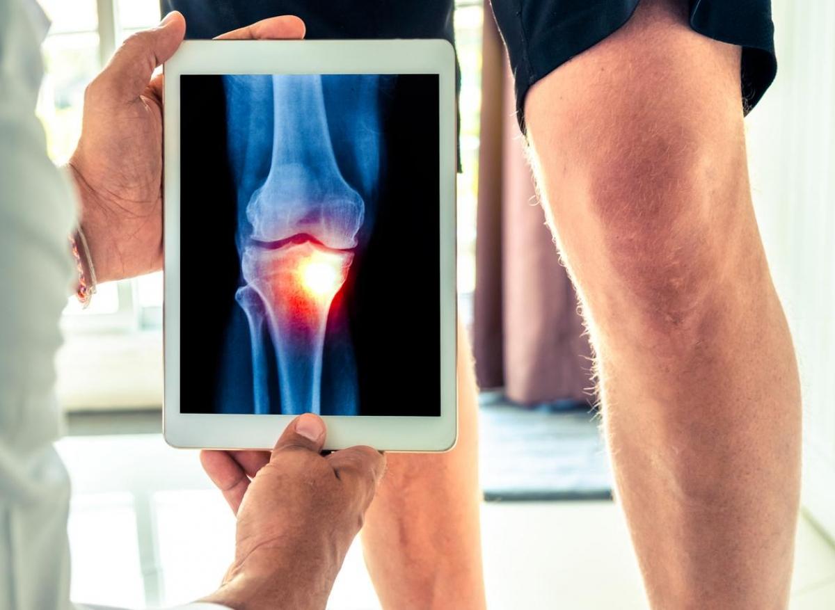 Arthrose : les infiltrations de corticoïdes remises en causes