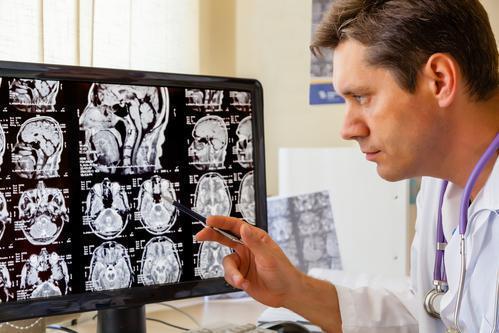 Migraine : une association très forte avec les dissections des artères cervicales