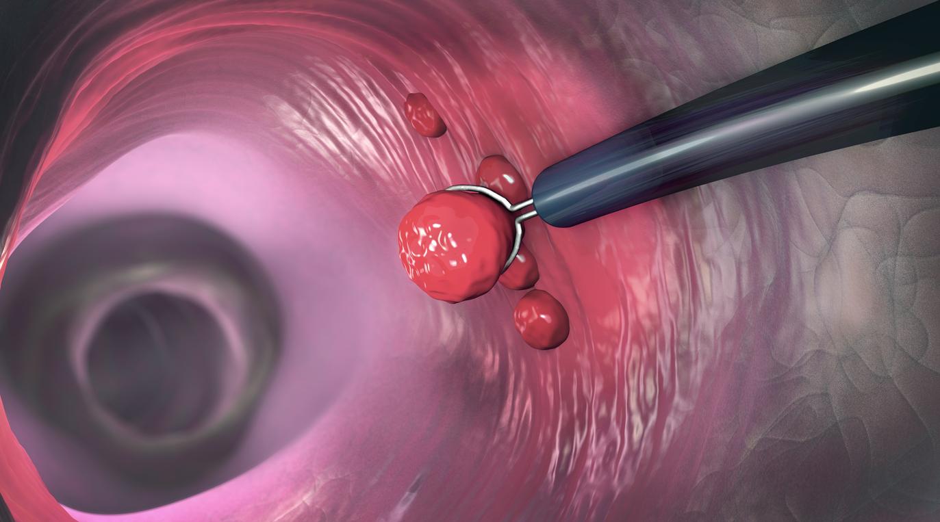 Cryobiopsie transbronchique : un intérêt diagnostique mitigé pour les pneumopathies interstitielles