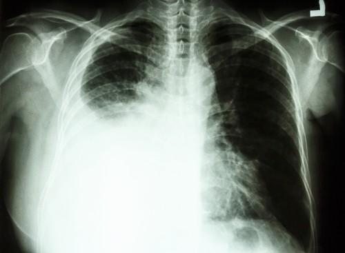 Cancer du poumon : le scanner ne permet pas un dépistage optimal selon l'HAS