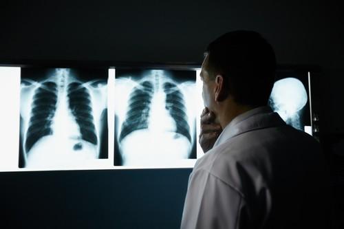 Cancer du poumon : l’immunothérapie efficace en première ligne