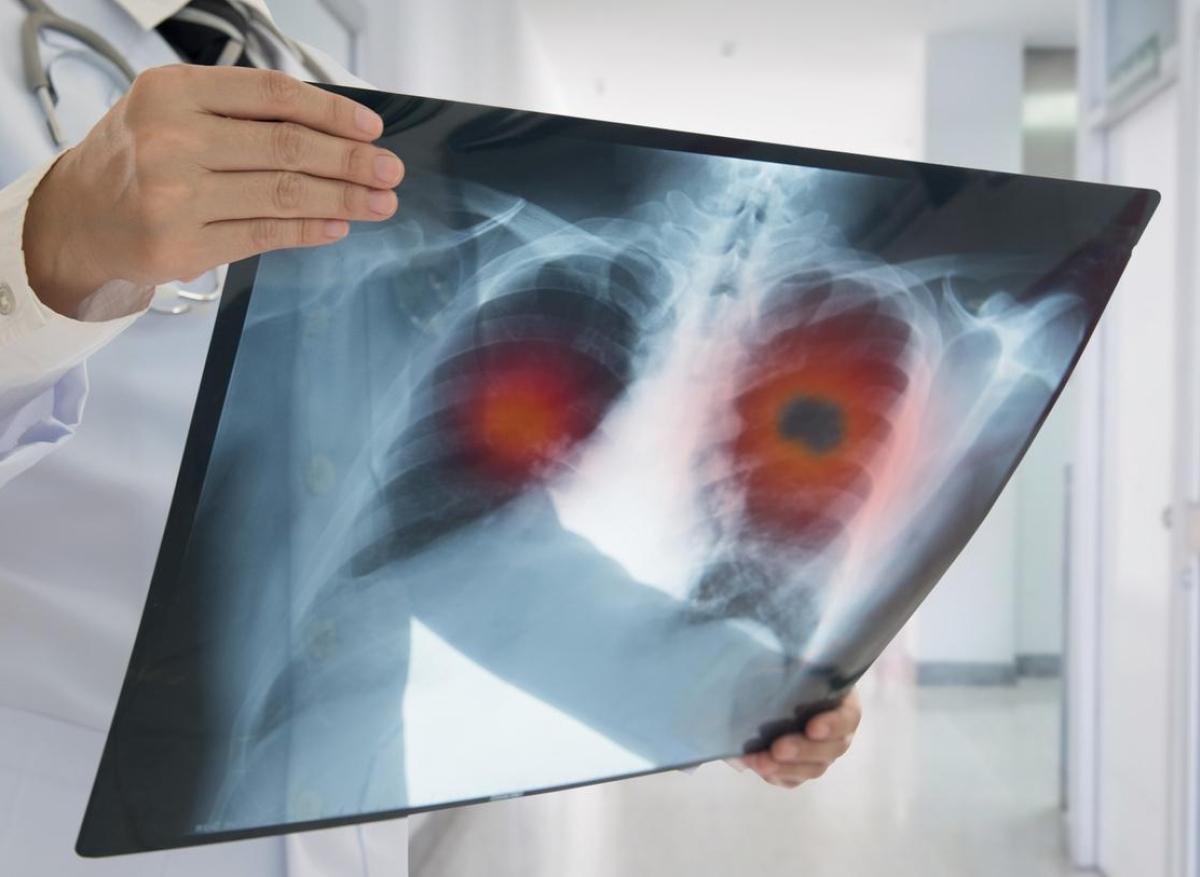 Cancer du poumon : une double greffe réussie chez un malade en stade avancé