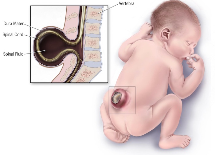 Spina bifida : deux bébés opérés dans l’utérus
