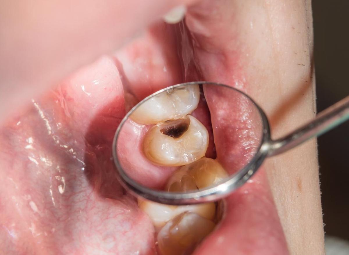 Caries : une nouvelle bactérie responsable identifiée