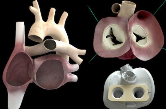 Carmat : implantation du coeur artificiel au Kazakhstan