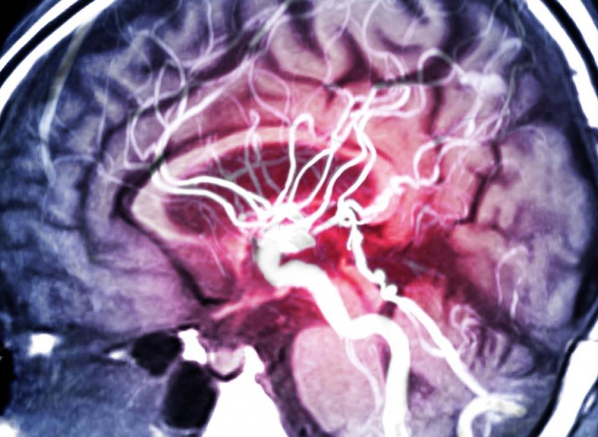 Anévrysme : le risque d'AVC est multiplié par 2,5 chez le jumeau qui fume