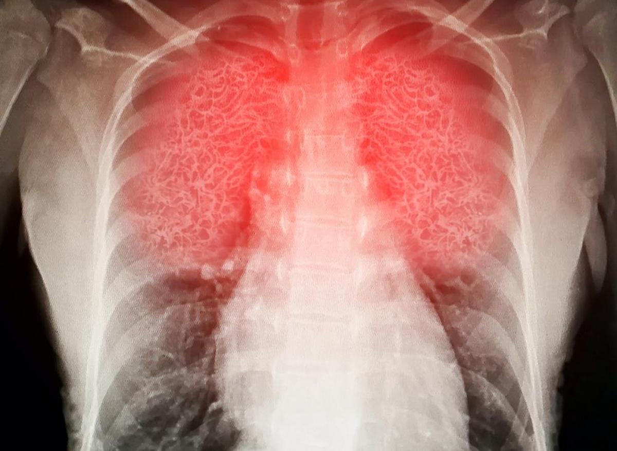 Covid-19 : des lésions pulmonaires à l'origine de troubles chroniques