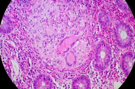 Vedolizumab : un profil de tolérance favorable dans le traitement des MICI