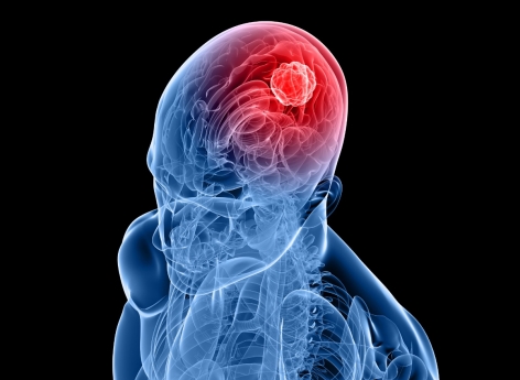 Cancer : des cellules du cerveau jouerait un rôle dans le développement des métastases