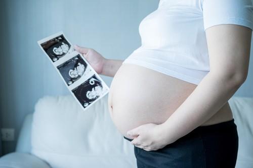 Trisomie 21 : Saisie du Conseil d'Etat sur le dépistage prénatal