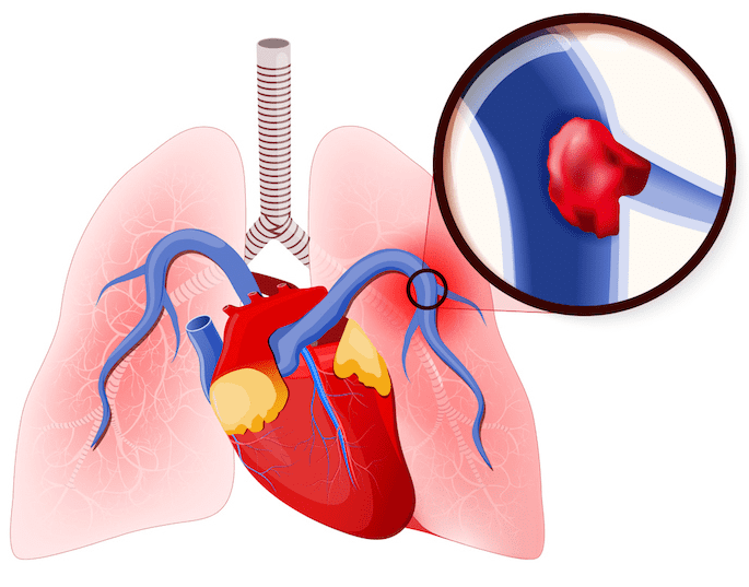 Embolie pulmonaire : doit-elle systématiquement être recherchée en cas de syncope ?