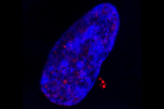 Cancers : la responsabilité du virus Epstein-Barr s'élargit