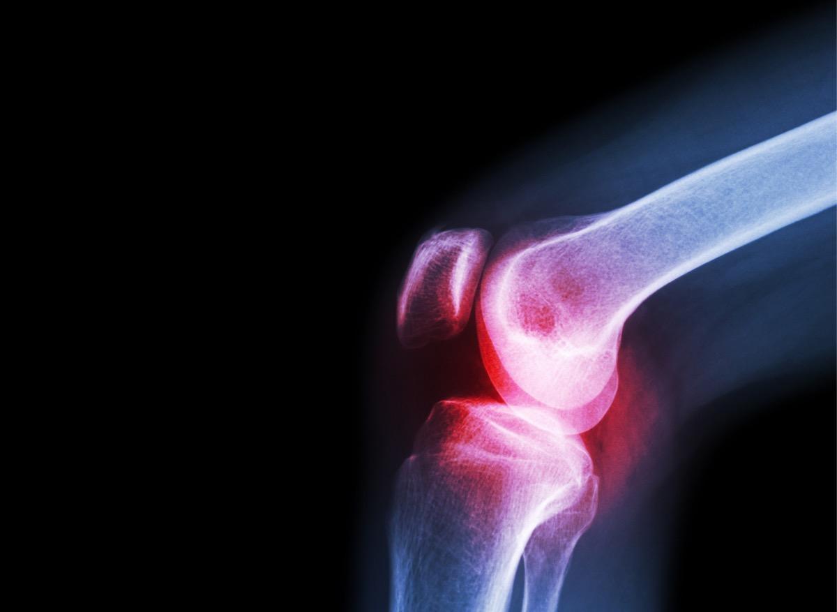 Arthrose du genou : un hydrogel prometteur pour remplacer le cartilage