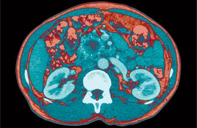 Cancer du pancréas : intérêt du traitement adjuvant par gemcitabine et capécitabine