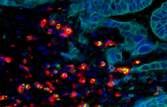 Métastases : prépondérance du microenvironnement tumoral et de l'immunité