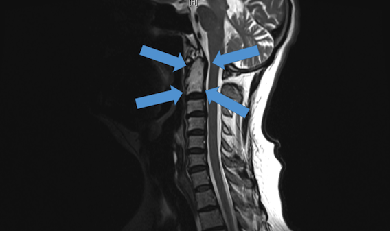 Chordome cervical : des vertèbres imprimées en 3D sauvent un australien