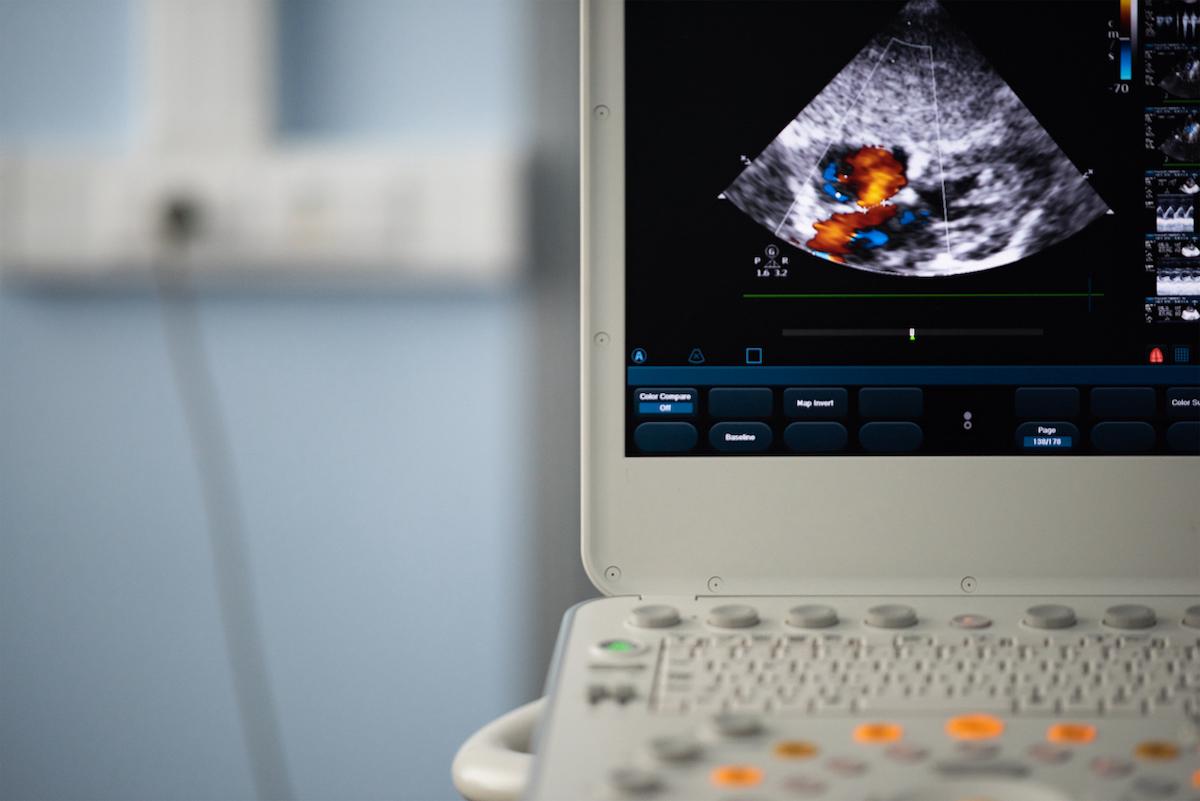 Foramen ovale, fibrillation atriale et AVC : quelle stratégie ?