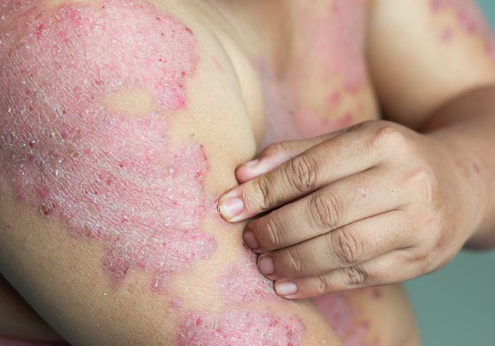 Psoriasis étendu : certaines biothérapies donnent moins d’infections que d’autres