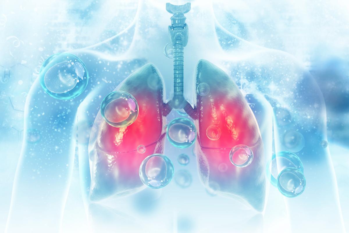 CBNPC métastatique : double immunothérapie et désescalade de la chimiothérapie