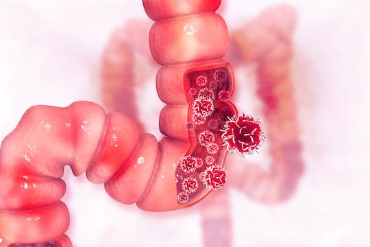 Métastases hépatiques des cancers colorectaux : résection coelio- ou laparoscopique ?