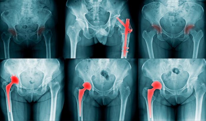 Ostéoporose: la densité minérale osseuse est le principal facteur de risque de fracture