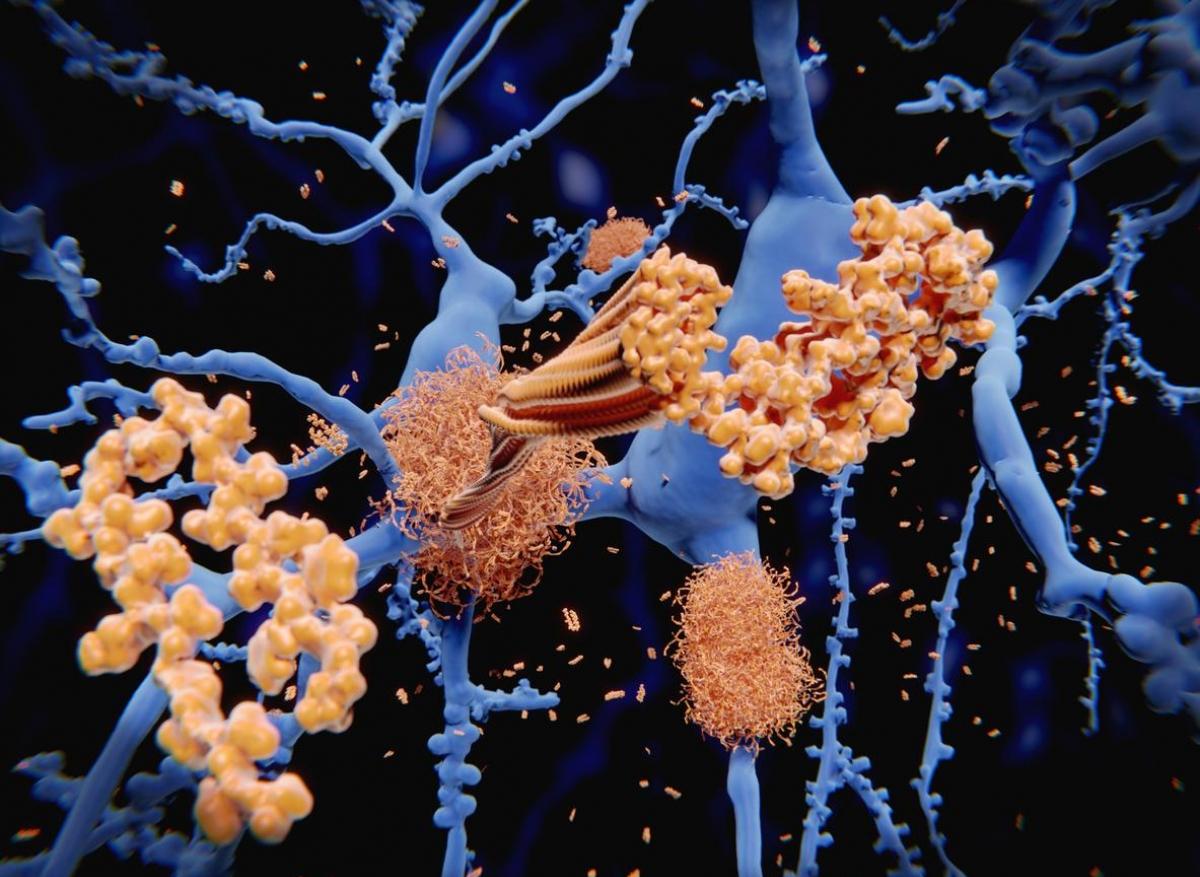 Alzheimer : controverse sur l'intérêt de cibler les plaques bêta-amyloïdes