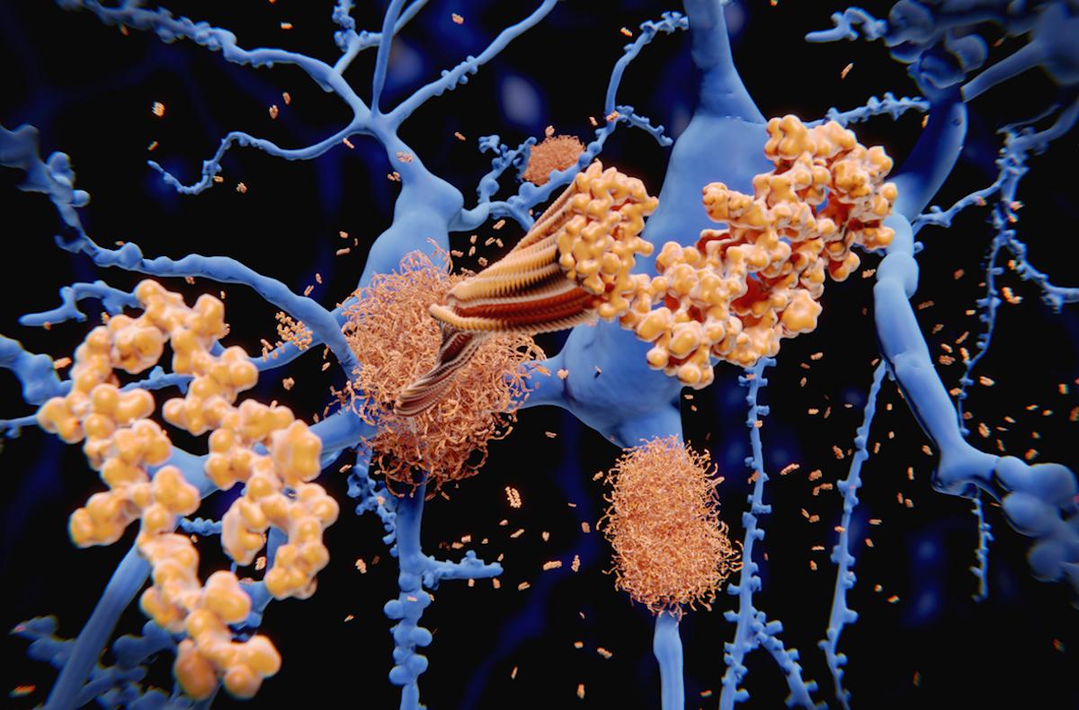 Maladie d’Alzheimer : intensification de la polémique sur les anticorps anti-amyloïde