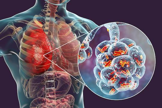 Covid-19 : les formes graves auraient une maladie vasculaire, virale et inflammatoire