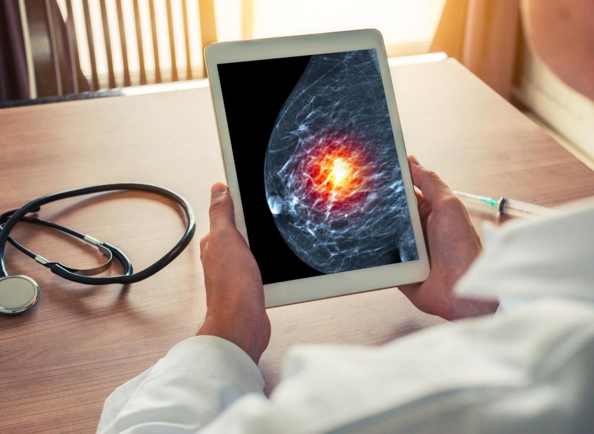 Cancer du sein : baisse des dépistages en 2020
