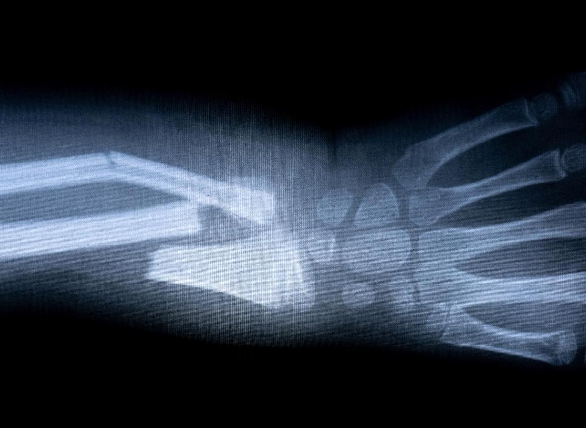 Fractures : une intelligence artificielle améliorerait leur diagnostic aux urgences