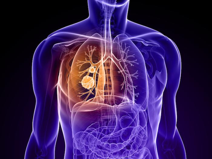 Cancer du poumon métastasé : une double immunothérapie efficace 