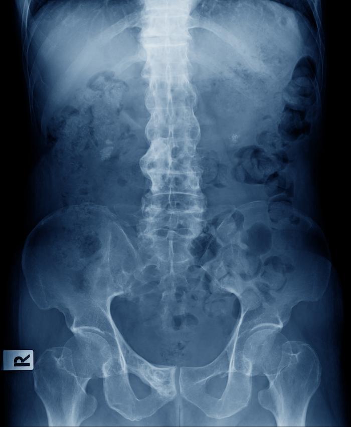 Spondylarthrite ankylosante : la fréquence des fractures de la colonne vertébrale plus faible qu’attendue