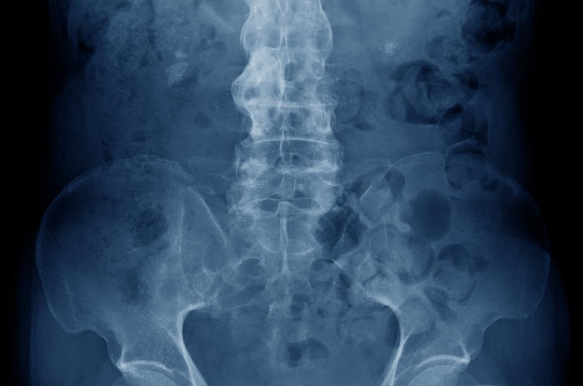 Spondylarthrite ankylosante : les AINS à forte dose augmentent le risque cardiovasculaire