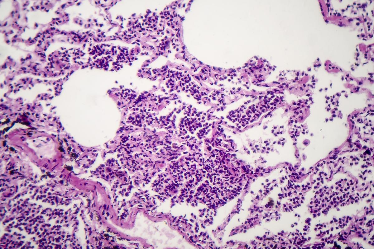 Fibrose pulmonaire et maladies auto-immunes : bénéfice d'un anti-fibrosant