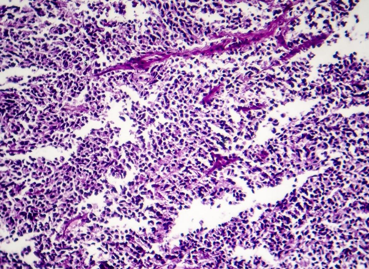 Cancer bronchique à petites cellules : quatre sous-types identifiés pour mieux adapter le traitement