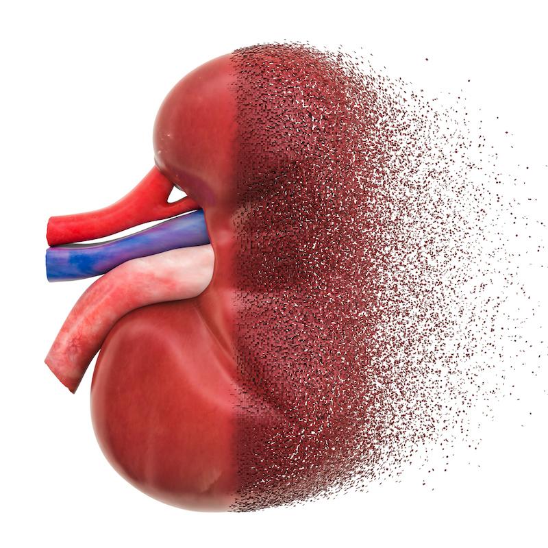 Diabète de type 2 : indications de la biopsie rénale.