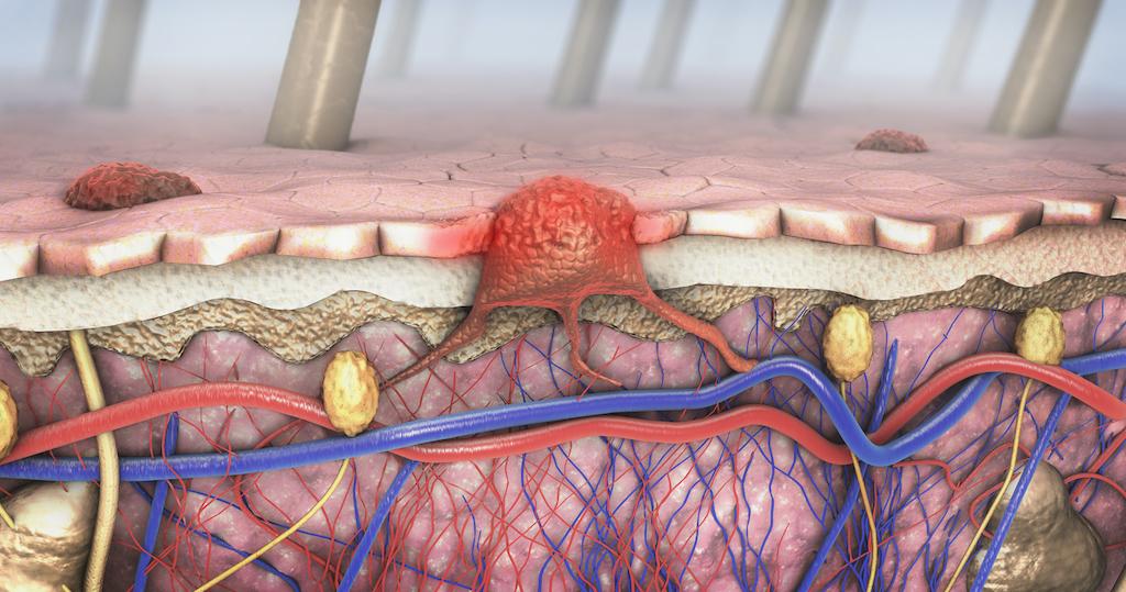 Mélanomes : un espoir dans les formes qui échappent à une immunothérapie 